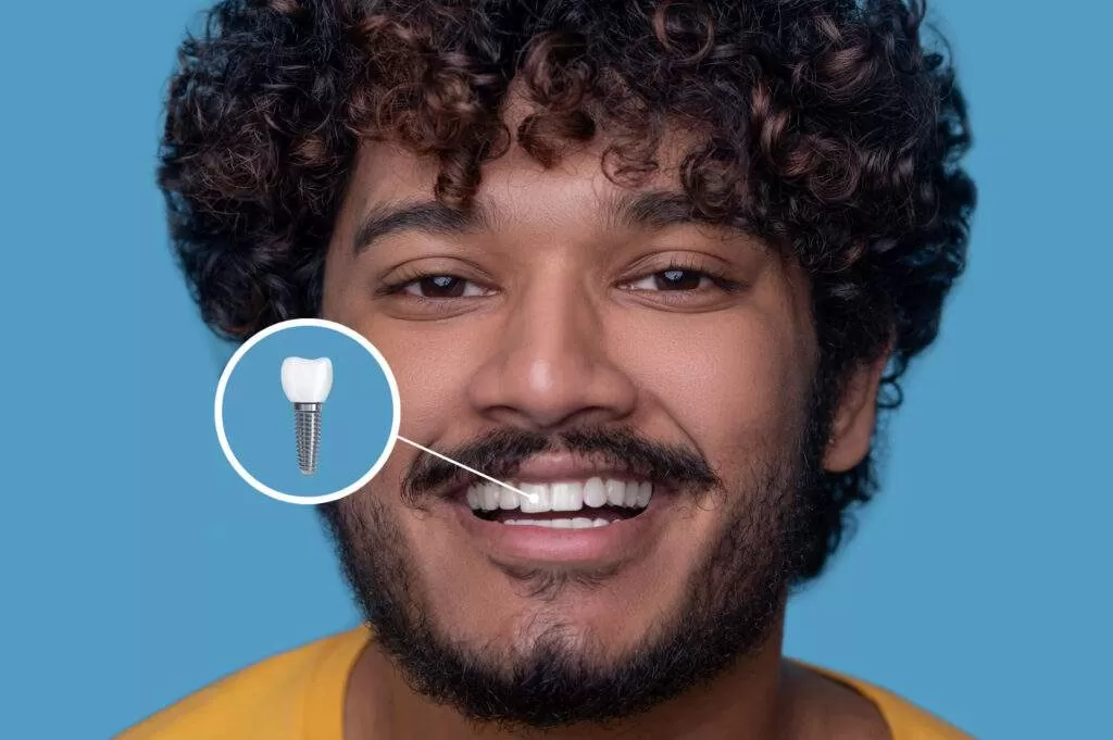 Sonrisa antes y después de un tratamiento de cirugía de implantes dentales en Endodental.